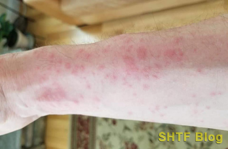 browntail moth rash